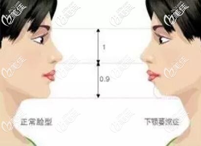正常下巴與后縮的下巴的對(duì)比照 正常下巴與后縮的下巴的對(duì)比照