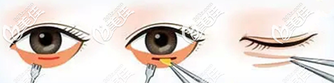 內(nèi)切法祛眼袋手術(shù)原理圖