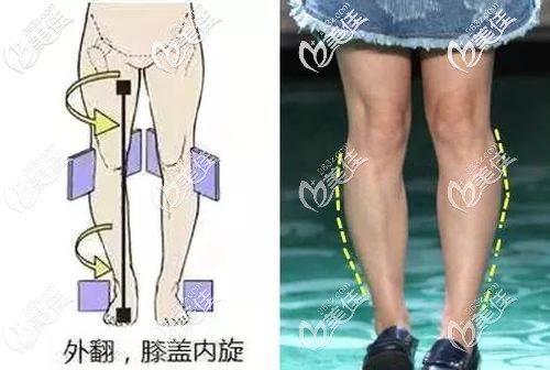 小腿外翻事例圖 小腿外翻事例圖