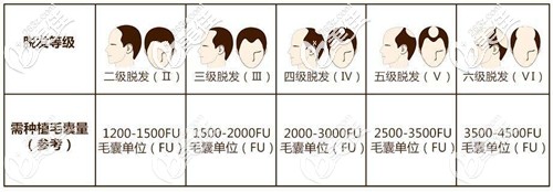 不同脫發(fā)等級毛囊種植圖 不同脫發(fā)等級毛囊種植圖