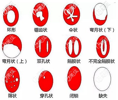 處女膜的所有形態(tài) 處女膜的所有形態(tài)