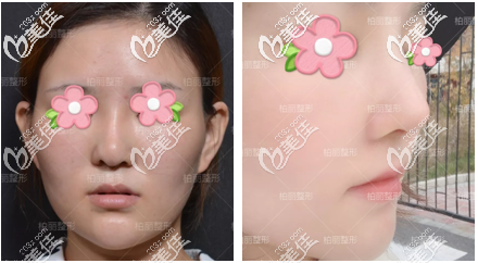 北京柏麗李勁良醫(yī)生鼻修復(fù)案例 北京柏麗李勁良醫(yī)生鼻修復(fù)案例