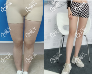 任學(xué)會醫(yī)生做大腿吸脂的手術(shù)案例 任學(xué)會醫(yī)生做大腿吸脂的手術(shù)案例