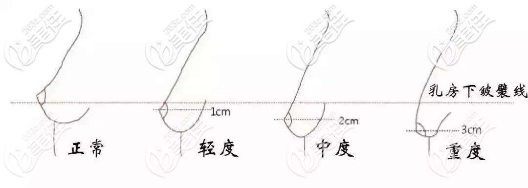 乳房下垂等級(jí)