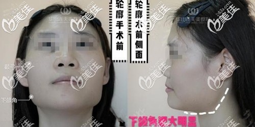 術(shù)前下頜角顴骨寬大