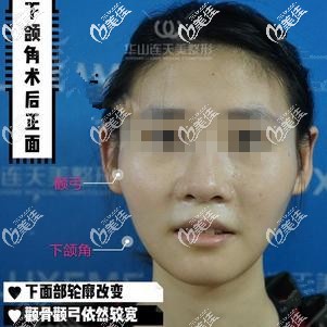 先做下頜角之后的效果