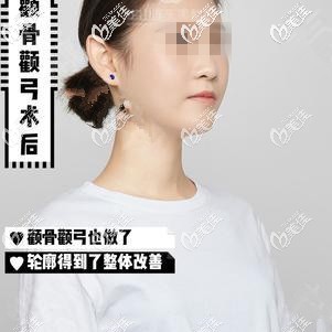 然后再做顴骨后的效果