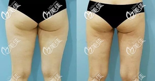 臀部吸脂前后對(duì)比案例