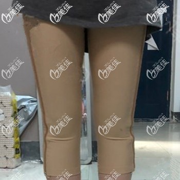 大腿吸脂一周后可以走路上班 大腿吸脂一周后可以走路上班