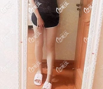 做大腿吸脂后因?yàn)闅埩舻哪[脹液疼痛感很輕 術(shù)后一周就走路上班了