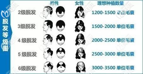 各級(jí)別脫發(fā)種植毛囊數(shù)量圖 各級(jí)別脫發(fā)種植毛囊數(shù)量圖