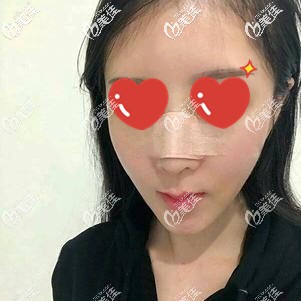 硅膠隆鼻術后即刻鼻梁明顯變高 硅膠隆鼻術后即刻鼻梁明顯變高