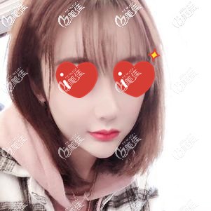 硅膠假體隆鼻術后10天拆線后鼻形自然 硅膠假體隆鼻術后10天拆線后鼻形自然