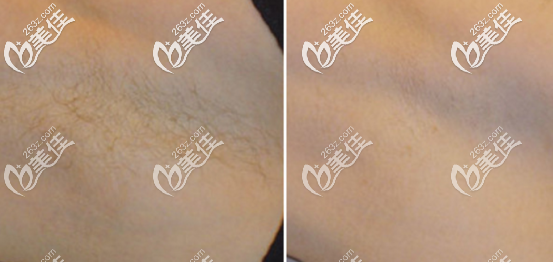 冰點脫毛案例圖