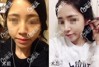 耳軟骨隆鼻對比案例 耳軟骨隆鼻對比案例