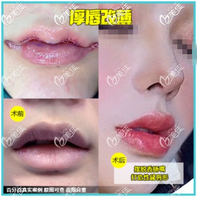 厚唇改薄術(shù)對比案例 厚唇改薄術(shù)對比案例