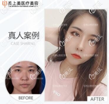 成都美上美隆鼻案例