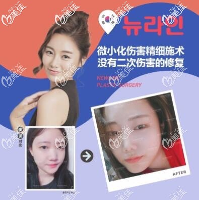 成都紐萊茵鼻綜合案例