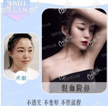 成都塑美大師混血隆鼻案例