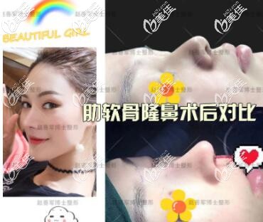 成都趙善軍博士肋軟骨隆鼻