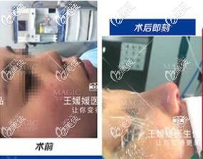 成都美極隆鼻案例