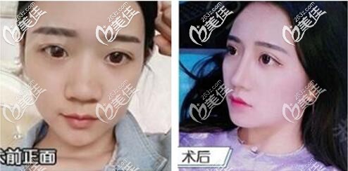 成都艾米麗高林隆鼻案例