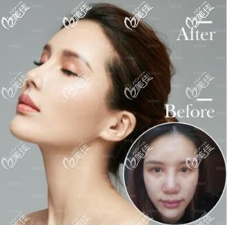 成都蜀尚蓉雅隆鼻