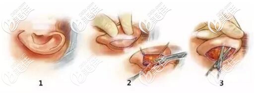 招風(fēng)耳矯正手術(shù)過程 招風(fēng)耳矯正手術(shù)過程