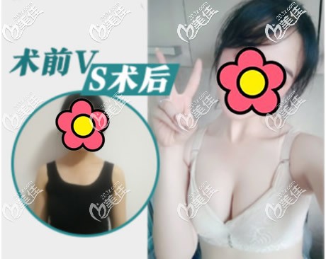 韓國(guó)蓓拉300cc毛面假體隆胸前后效果對(duì)比照片 韓國(guó)蓓拉300cc毛面假體隆胸前后效果對(duì)比照片