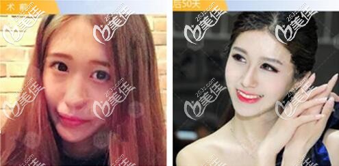 成都成美美容鼻綜合案例