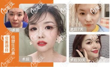 成都圣丹福隆鼻好不好