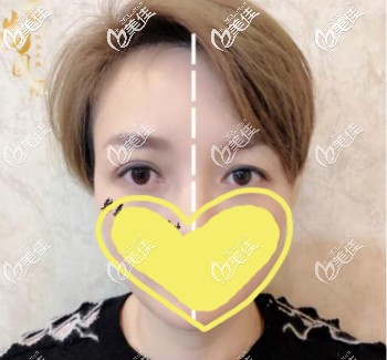 韓國me無痕雙眼皮15天效果 韓國me無痕雙眼皮15天效果