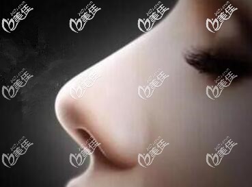 關(guān)于隆鼻假體取出發(fā)生攣縮的介紹