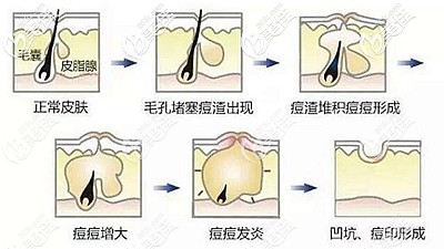 痘坑形成的原因 痘坑形成的原因