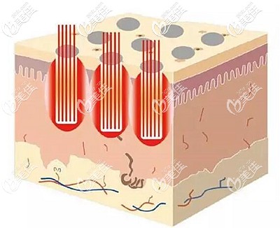 蜂巢皮秒可以去除痘坑痘印 蜂巢皮秒可以去除痘坑痘印