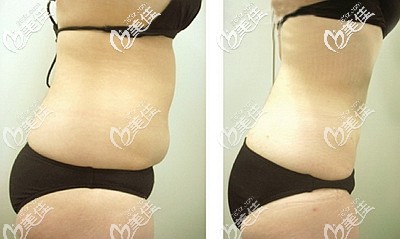 腰腹吸脂后的效果 腰腹吸脂后的效果