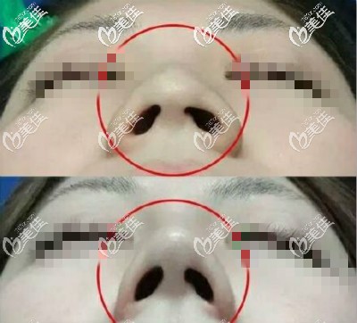 剛做完縮鼻翼三個月效果圖