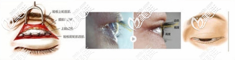 周洪超睫毛入路雙眼皮手術(shù)原理示意圖