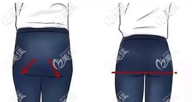 提臀線手術(shù)的位置