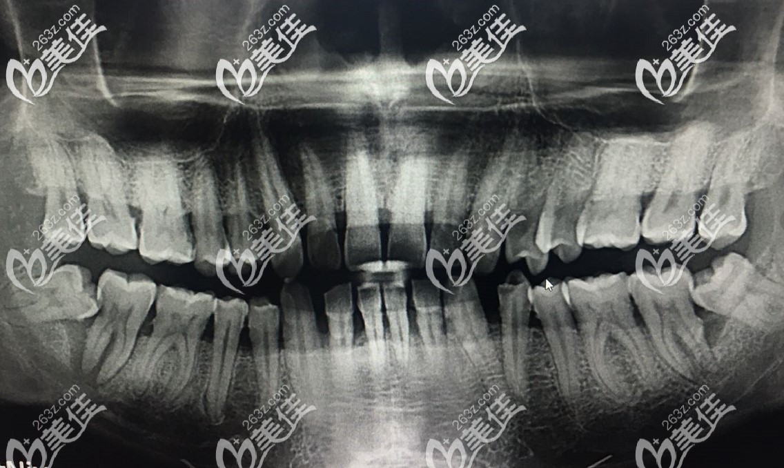 第二磨牙被智齒頂壞了是該做種植牙還是做根管治療