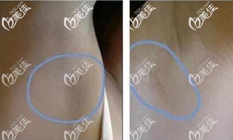腋下切口疤痕恢復(fù)效果