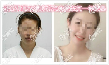 北京潤美玉之光王明利博士脂肪填充真人案例效果
