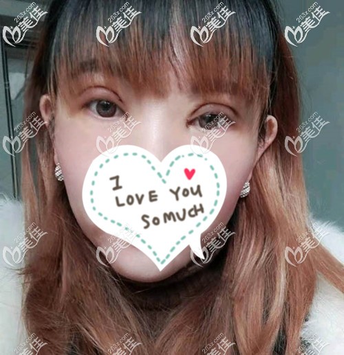 剛做完雙眼皮開眼角的時候眼睛并不是很腫