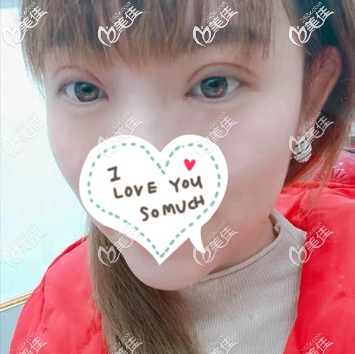 術(shù)后3天雙眼皮腫的特別厲害