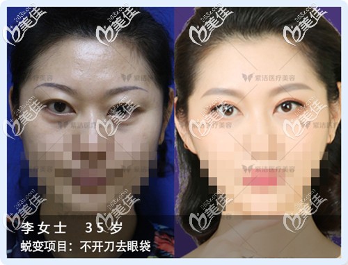 北京紫潔儷方不手術祛眼袋效果對比