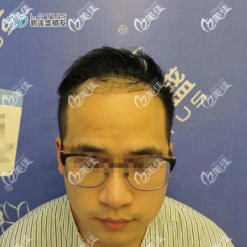 術(shù)前前額頭頂發(fā)際線脫發(fā) 術(shù)前前額頭頂發(fā)際線脫發(fā)