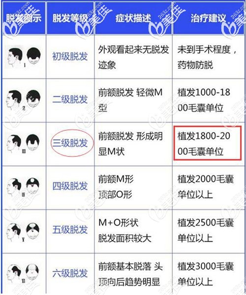 三級脫發(fā)所需毛囊個數(shù) 三級脫發(fā)所需毛囊個數(shù)