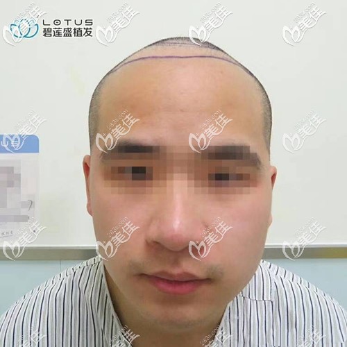 術(shù)前設(shè)計好了種植區(qū)域 術(shù)前設(shè)計好了種植區(qū)域