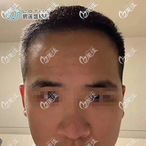 三級脫發(fā)需要多少毛囊多少錢?來看我做前額發(fā)際線植發(fā)1800單位效果圖，手術(shù)費準(zhǔn)備2萬就夠了