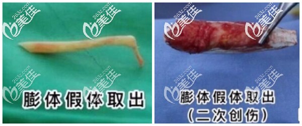 橫山醫(yī)生對比之前院內(nèi)取出的膨體材料